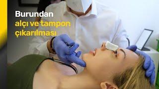 Burundan tampon çıkarılması - Burundan alçı çıkarılması Videosu - Op. Dr. Orhan Murat Özdemir