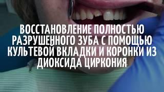 Восстановление полностью разрушенного зуба с помощью культевой вкладки и коронки из циркония