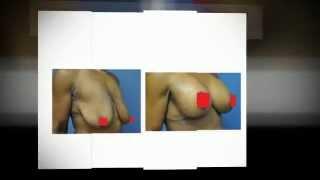 Breast Augmentation with Lift in Baltimore & DC