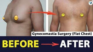 Gynecomastia Surgery Before After Results After 10 Days  Gynecomastia Surgery Before After Results