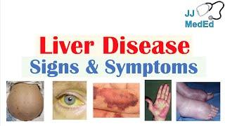 Liver Disease Signs & Symptoms ex. gynecomastia bruising  Hepatic Stigmata