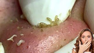 Satisfying Relaxing Blackhead Removal Video part#3