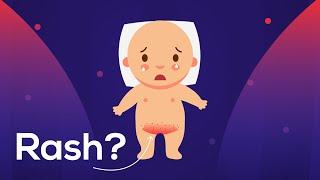 Diaper Rash Due to Baby Urine or Fungus? & Helpful tips to cure