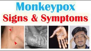 Monkeypox Signs & Symptoms First Symptom & Stages of Rash