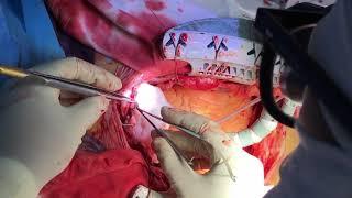 Off-Pump Coronary Artery Bypass I- and T-Graft Technique With No-Touch Aorta