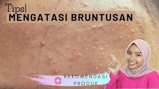 PENYEBAB BRUNTUSAN + TIPS AMPUH MENGATASI BRUNTUSAN