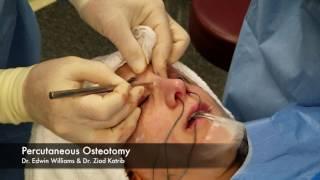 Percutaneous Osteotomy & Breaking the Nose During Rhinoplasty Surgery