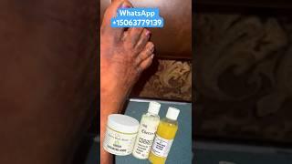 How to treat dark feet using skin corrector lotion #music #unitedstates