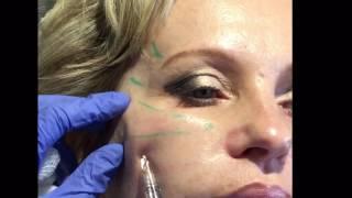 Juvederm VOLUMA filler for facial rejuvenation