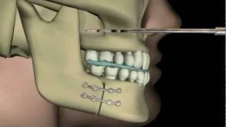 Çift Çene AmeliyatıUpper and Lower Jaw Surgery