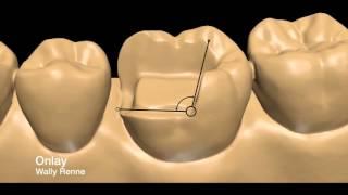 Posterior tooth preparations inlay onlay crownlay and crown