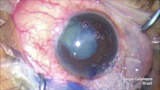 Coloboma - New cataract surgery approach with Canabrava ring