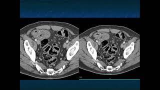CT of the Small Bowel Complications of Therapy and How They Mimic Pathology - Part 1