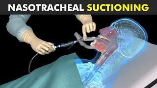 How Nasotracheal Suctioning Is Performed?