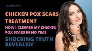 Chicken pox scars treatment  How to get rid of chickenpox scars naturally