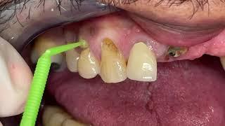 Houston Cosmetic Dentist...Step by Step removal of gum line decay...Invisible restorations