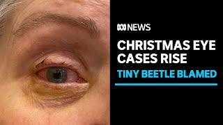 Christmas eye cases on the rise caused by tiny beetle you wont see coming  ABC News