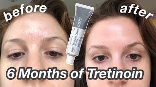 6 Month TretinoinRetin-A Update Before & After + My Current Skincare Routine