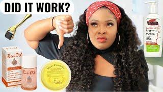 I Tried TOP 5 STRETCH MARKS REMOVAL PRODUCTS  Best Products To Remove Stretch Marks