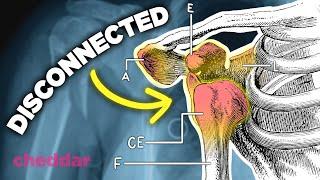 Why The Human Shoulder Is A Design Disaster - Cheddar Explains