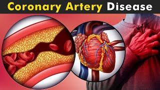 How Coronary Artery Disease Work?  Symptoms Causes And Treatment UrduHindi