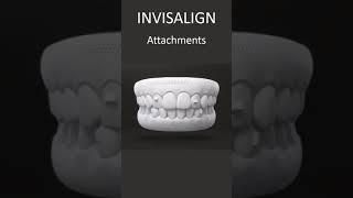 Invisalign Attachments  How They Work  London UK