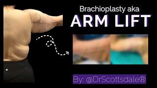 High BMI Brachioplasty aka ARM LIFT by @DrScottsdale®