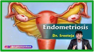 Endometriosis  Causes Signs and symptoms Pathophysiology Diagnosis and Treatment  Gynecology