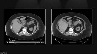 Small Bowel Emergencies   Interesting Radiology Cases