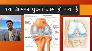 क्या आपका घुटना जाम हो गया है ? घुटना जाम हो जाये तो क्या करें ? Stiff Knee Treatment