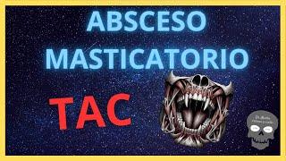 ABSCESO MASTICATORIO  Hallazgos Radiológicos