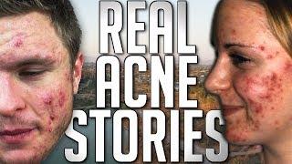 Emotional Struggle of Acne  REAL PEOPLES STORIES