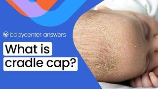 What is cradle cap?