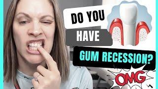 What Gum Recession Looks Like and How To Stop It