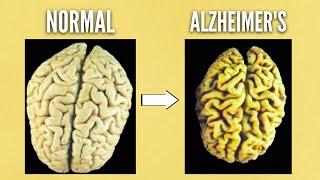 The BIGGEST  reason people get Alzheimers Disease DEMENTIA