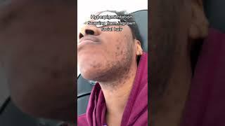 Doctor does Laser hair removal for facial hair hyperpigmentation and scarring. Dark skin tone