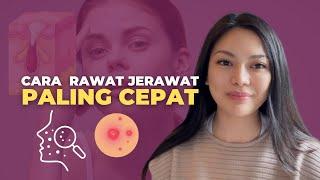 Beauty Tips  Cara Rawat Jerawat Paling Cepat