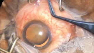 New Management for Subluxated Cataract - Canabrava Sutureless Technique - Double Flanged for CTR