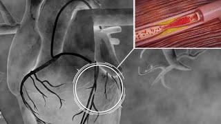 A Coronary Angiogram is a procedure that provides doctors with a better understanding of the artery
