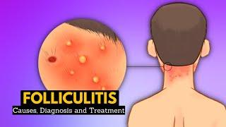 Folliculitis Causes Signs and Symptoms Diagnosis and Treatment.