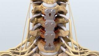 $650K Result Animated C4-7 Anterior Cervical Discectomy with Fusion