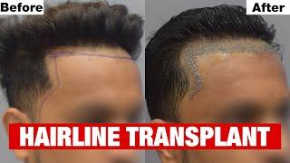 Natural Looking Hairline Transplant at Cara using Sapphire FUE Method