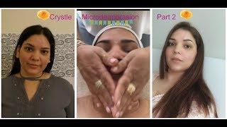 Crystal Microdermabrasion part 2 Acne scar reduction treatmentGlowing Skin