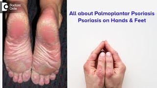 All about Palmoplantar Psoriasis  Psoriasis on hands & feet - Dr. Rajdeep Mysore  Doctors Circle
