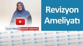 Ayak Bileği Kıkırdak Lezyonu Revizyon Ameliyatı  Prof. Dr. Tahir Öğüt