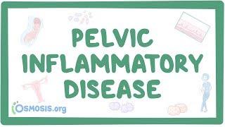 Pelvic inflammatory disease - causes symptoms diagnosis treatment pathology