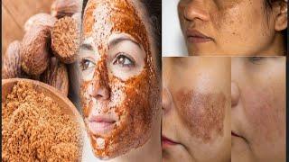 Best pigmentation tips for skin  कितनी बी  पुरानी पिग्मेंटेशन हो आज ही लगाके देखो