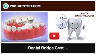 Dental Bridge Cost  A Video by Dr. Thomas Nechupadam