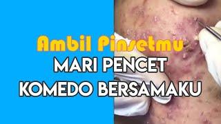 Jangan Malu Kawan Ambil Pinsetmu Mari Pencet Komedo Bersamaku