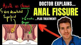 Doctor explains ANAL FISSURE including causes classification and treatment options